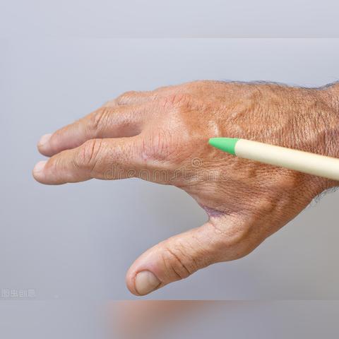 风湿最新疗法进展,科学精准高效治疗风湿病